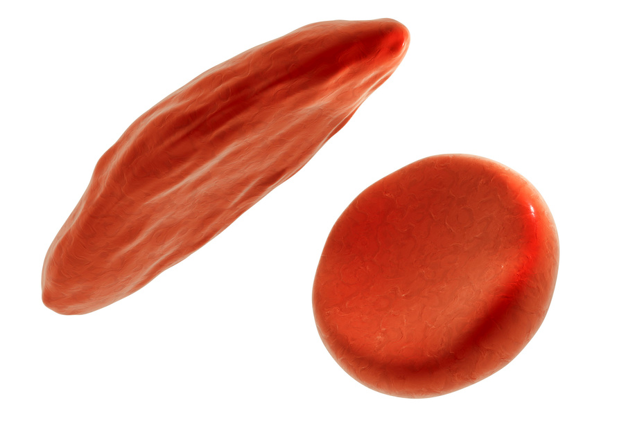 Computer illustration of normal red blood cells and crescent-shaped red blood cells as found in sickle cell anaemia.